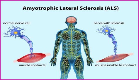 
James Yeager Illness: What Is ALS Disease? Symptoms And Health Update 